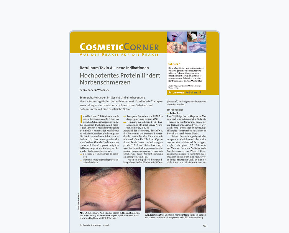 Botulinum Toxin A – neue Indikationen