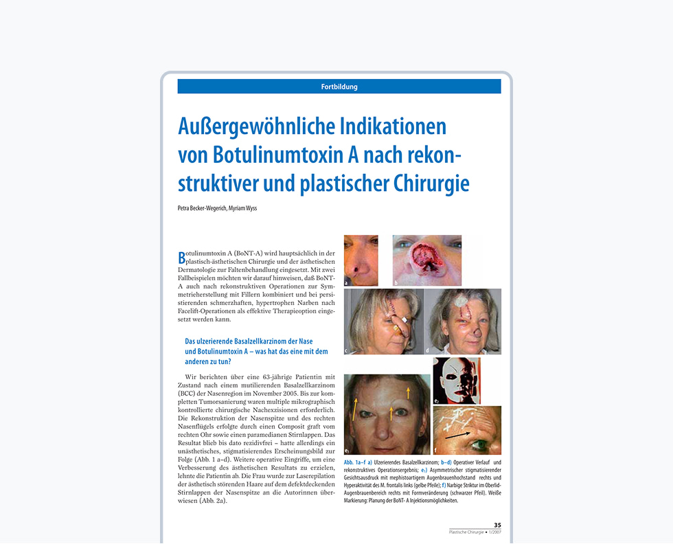 Aussergewoehnliche-Indikationen-von-Botulinumtoxin-A