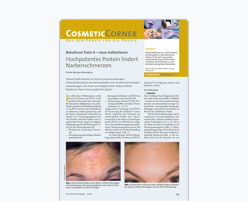 Botulinum Toxin A (Botox®, Dysport®, Xeomin®) – Hochpotentes Protein lindert Narbenschmerzen