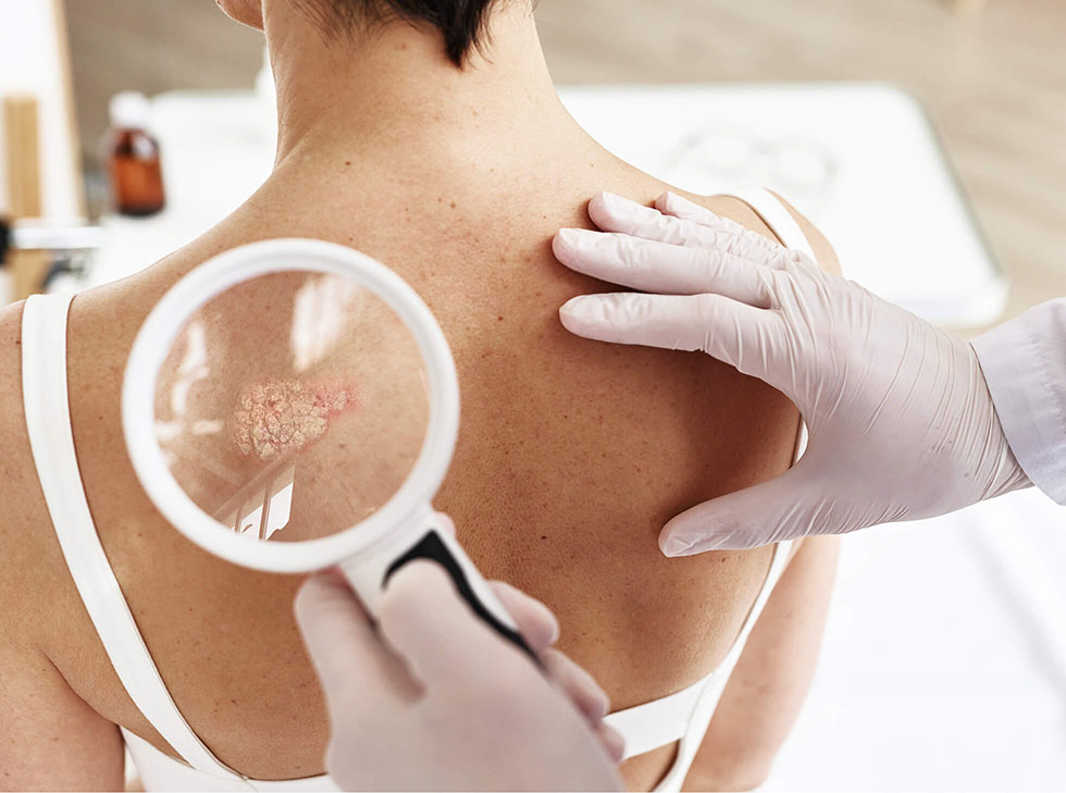 Dermatologe Untersucht Hautveränderung An Rückenhaut