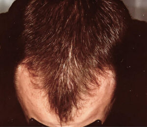 Haarausfall Behandlung Nachher