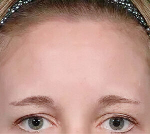 Pigmentstoerung Stirn Nachher Klar