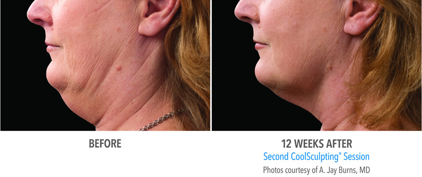 Sm Burns 121f 2set 18wk2 Left