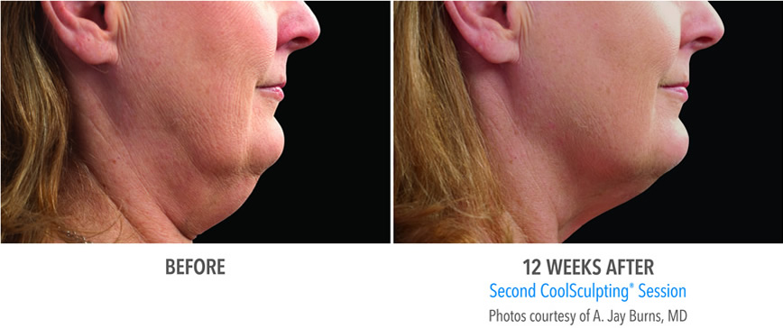 Sm Burns 122f 2set 18wk2 Right