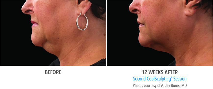Sm Burns 2set 18wk2 Left