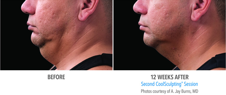 Sm Burns 8m 2set 18wk2 Left