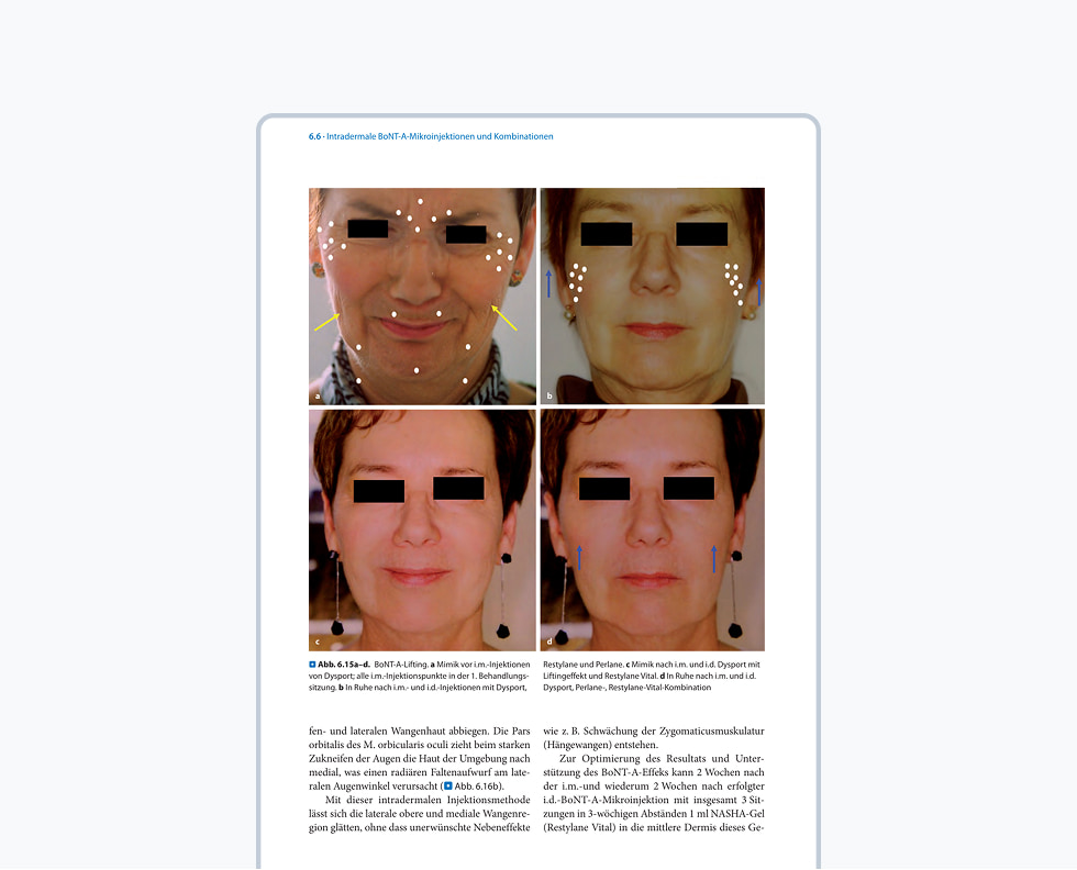 Faltenbehandlung mit Botulinumtoxin A und besondere Indikationen