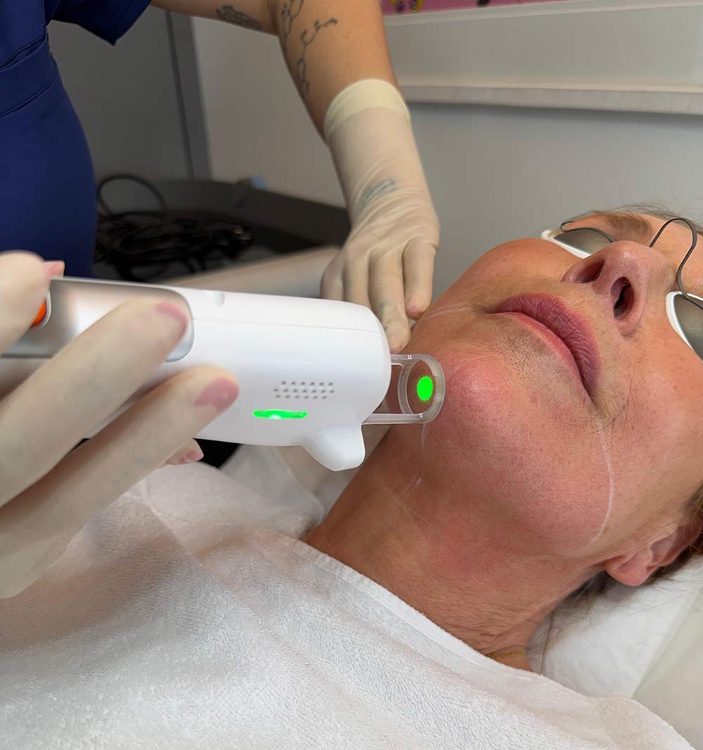 Lasertoning