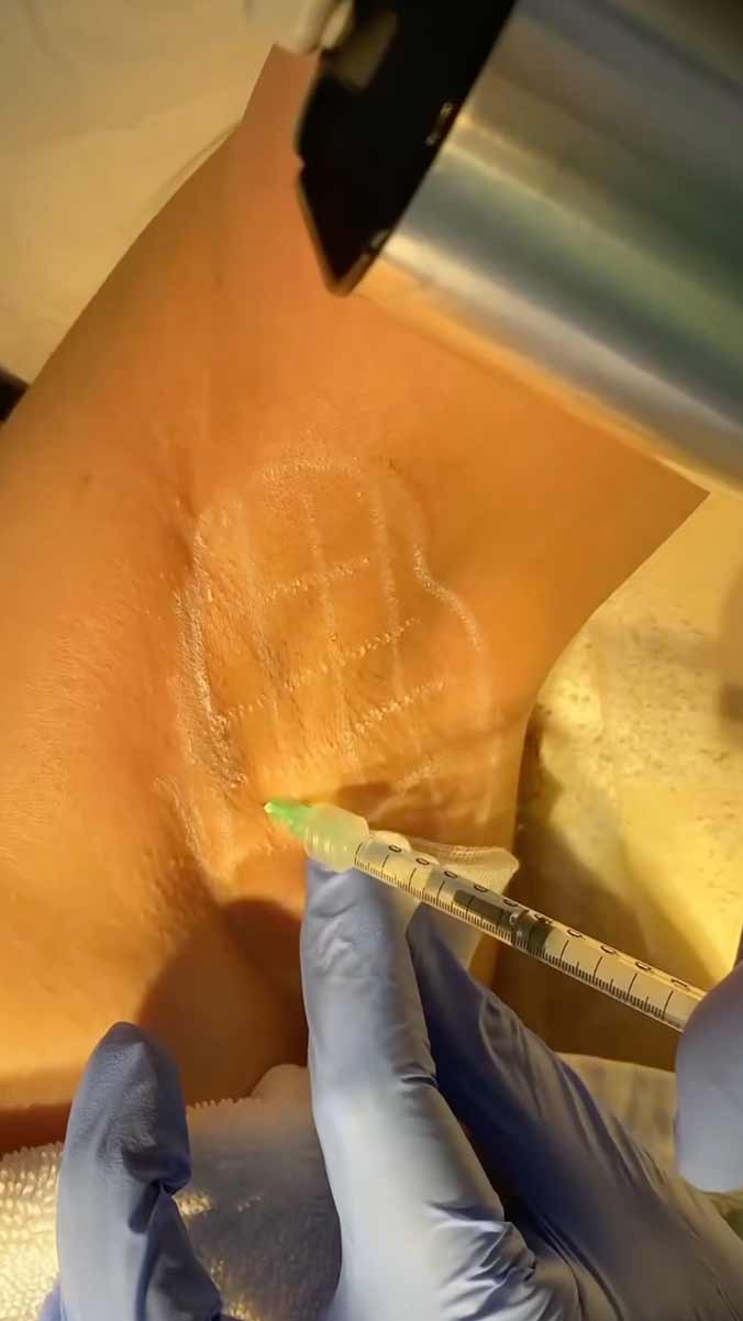 Botox Gegen Uebermaessiges Schwitzen